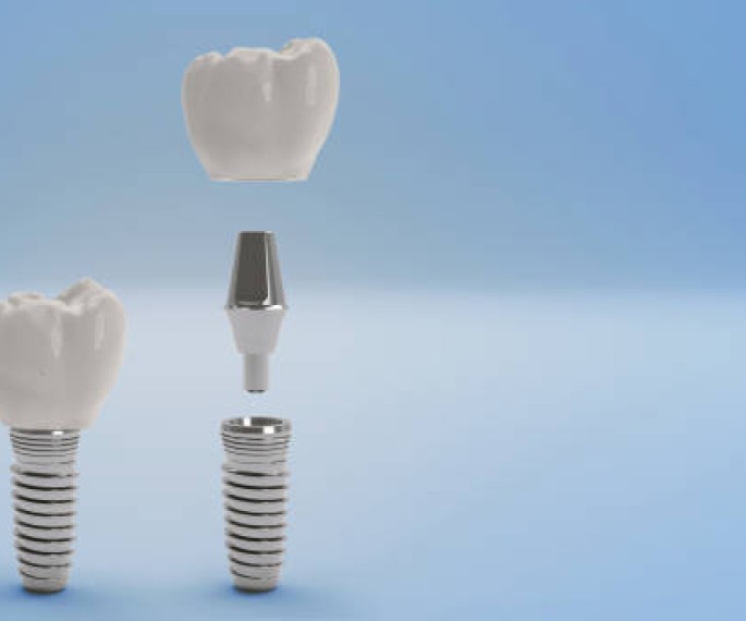 Implant single